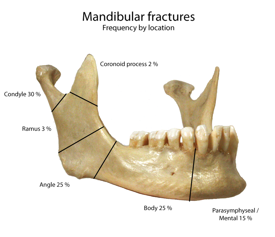 mandbular_fractures